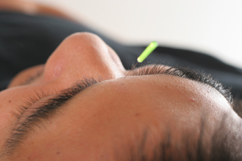 The Healing Art of Acupuncture