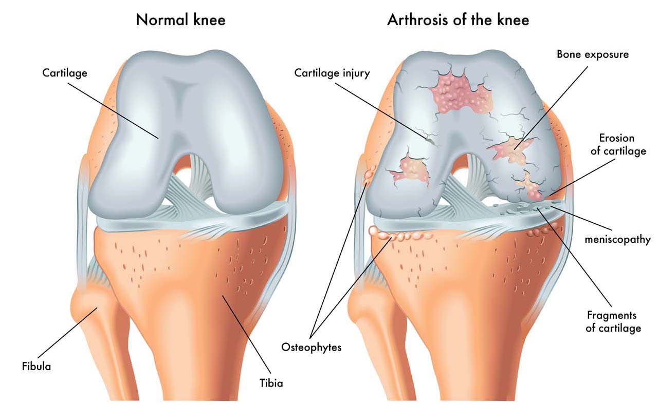 artritis i artroza nsaid tretmana